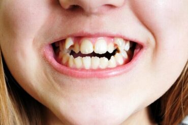 Răng khểnh là gì